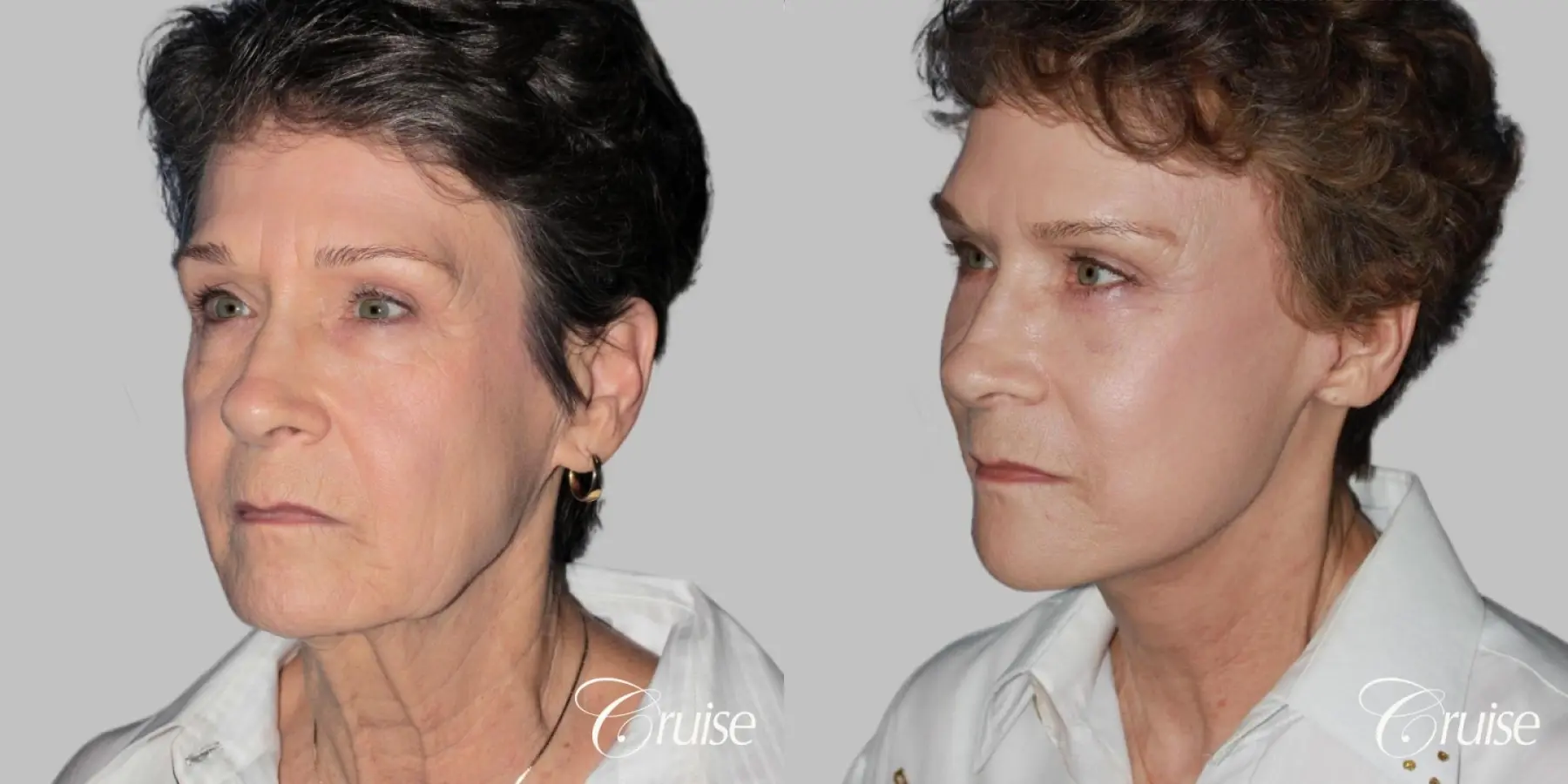 Female Facelift, Blepharoplasty, Necklift, and Temple Lift - Before and After 2