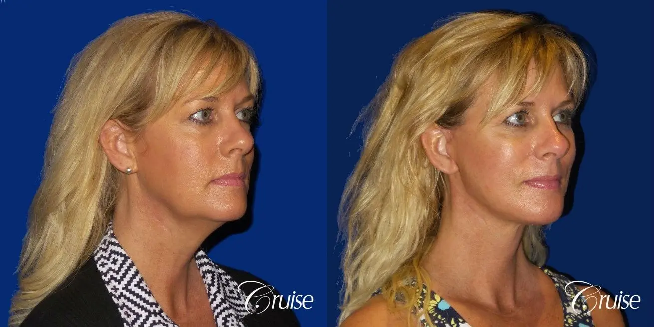 Neck Lift With Lower Face Lift - Before and After 2