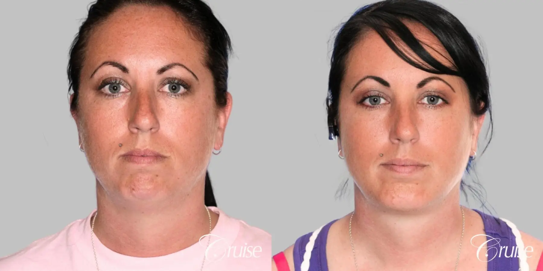 Neck Lift with Chin Augmentation - Female - Before and After 1