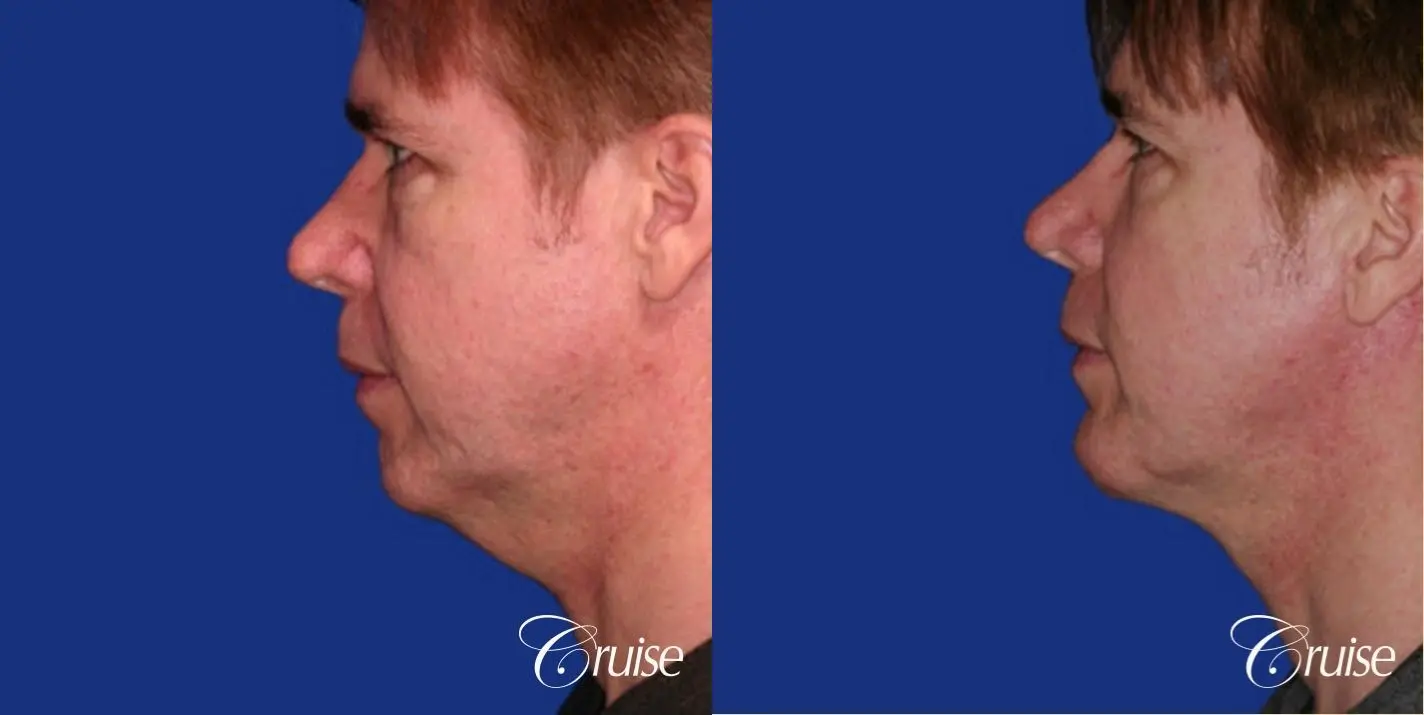 Neck Lift - Before and After 2