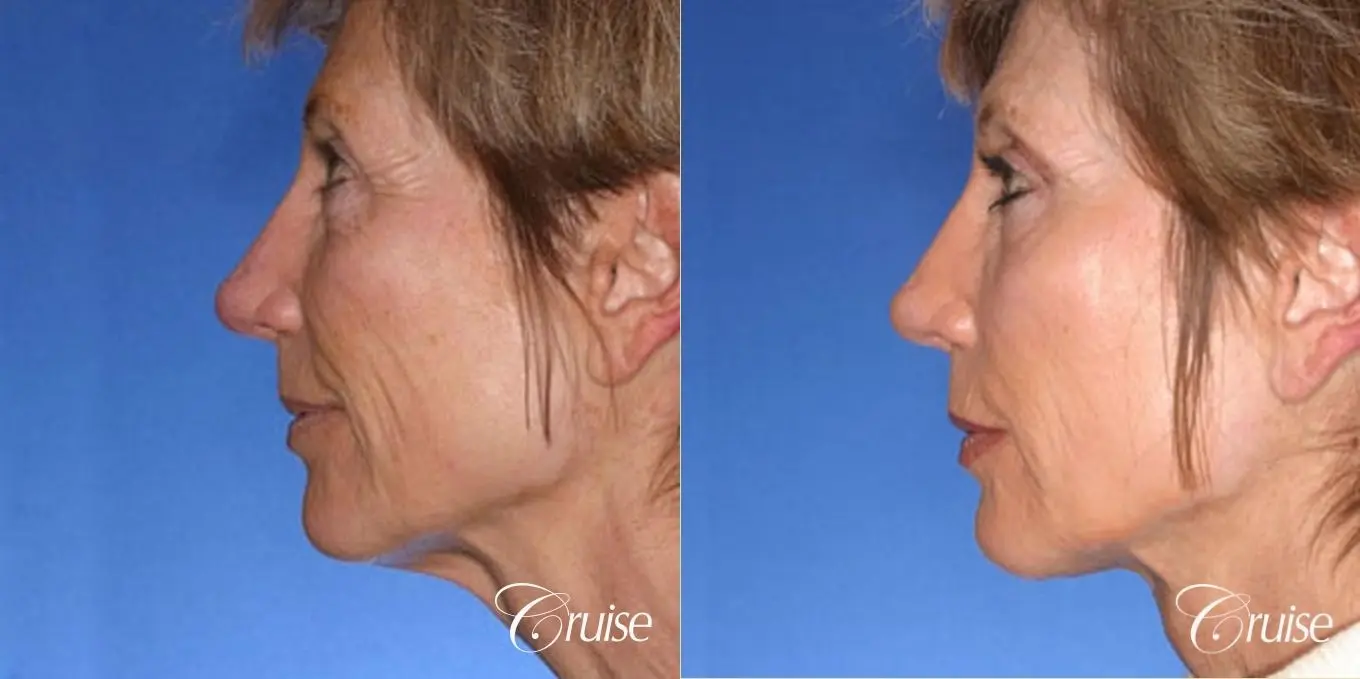 Neck Lift - Before and After 1