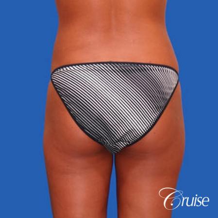 best liposuction abdomen and love handles - After Image 3