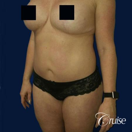 Best tummy tucks dr cruise - After Image 3
