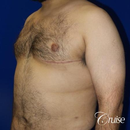 Gynecomastia -Free Nipple Graft - After Image 2