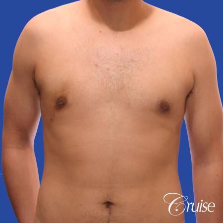 mild gynecomastia standard PA areola incision - After Image 1