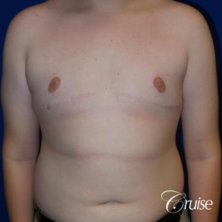 young boy with gynecomastia during puberty gets surgery - After Image 1