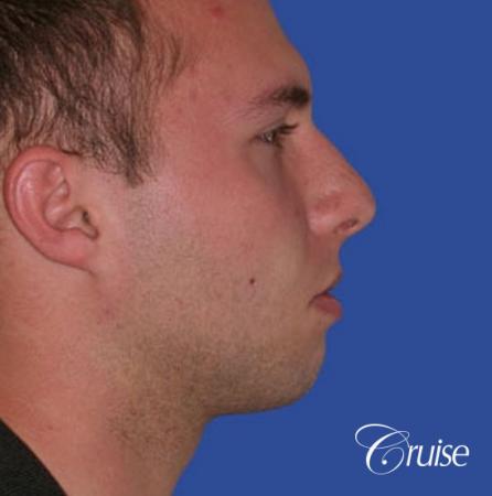 best chin implant on male with medium square jaw - Before Image 3