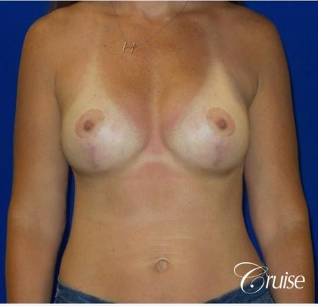 Breast Revision: Patient 2 - After Image 1