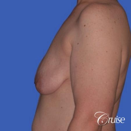 best photos of breast lift anchor on 39 yr old - Before and After Image 2