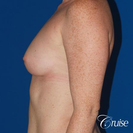 Breast Augmentation - Before Image 2