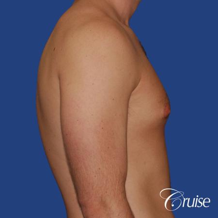 young adult with puffy nipple gets the best results with top gynecomastia surgeon - Before and After Image 2