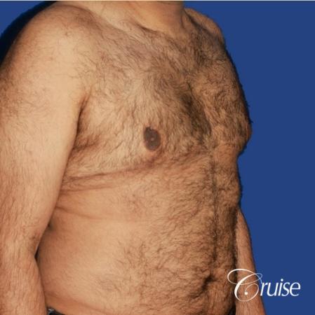 40 year old with severe gynecomastia results - After Image 2