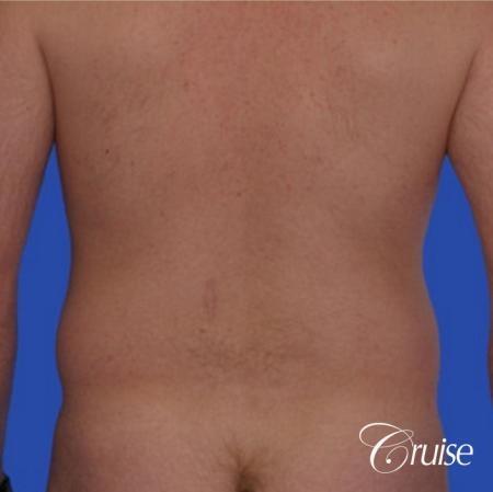 male muffin top liposuction pictures - Before Image 1