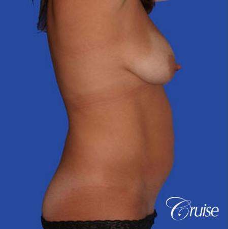 mommy makeover with best breast lift anchor with saline implants - Before Image 3