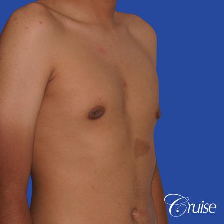 gynecomastia patient gets nipple reduction for best results - After Image 5