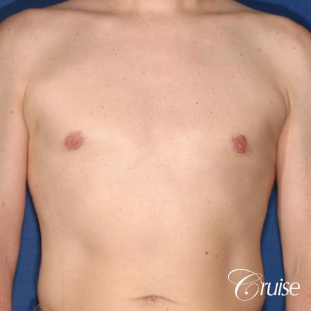 moderate gynecomastia on adult with donut lift scar - After Image 1