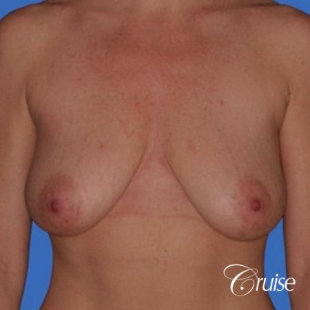 no implants with breast lift anchor - Before Image 1