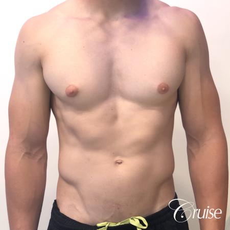 gynecomastia with puffy nipples - Before Image 1