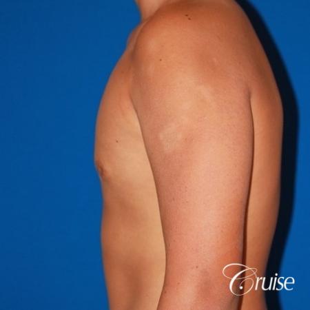 severe puffy nipple on teenager - After Image 2