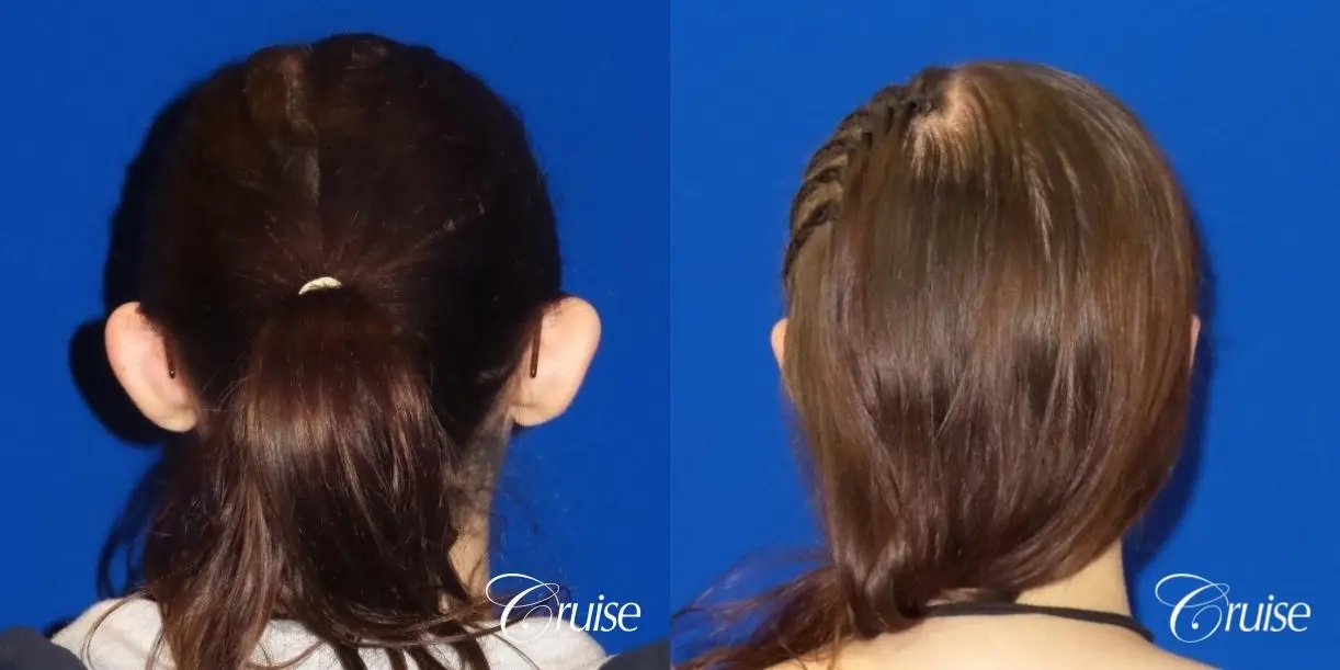 Otoplasty And Earlobe Repair: Patient 2 - Before and After 2