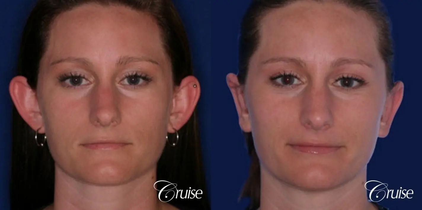 best female otoplasty in orange county - Before and After 1