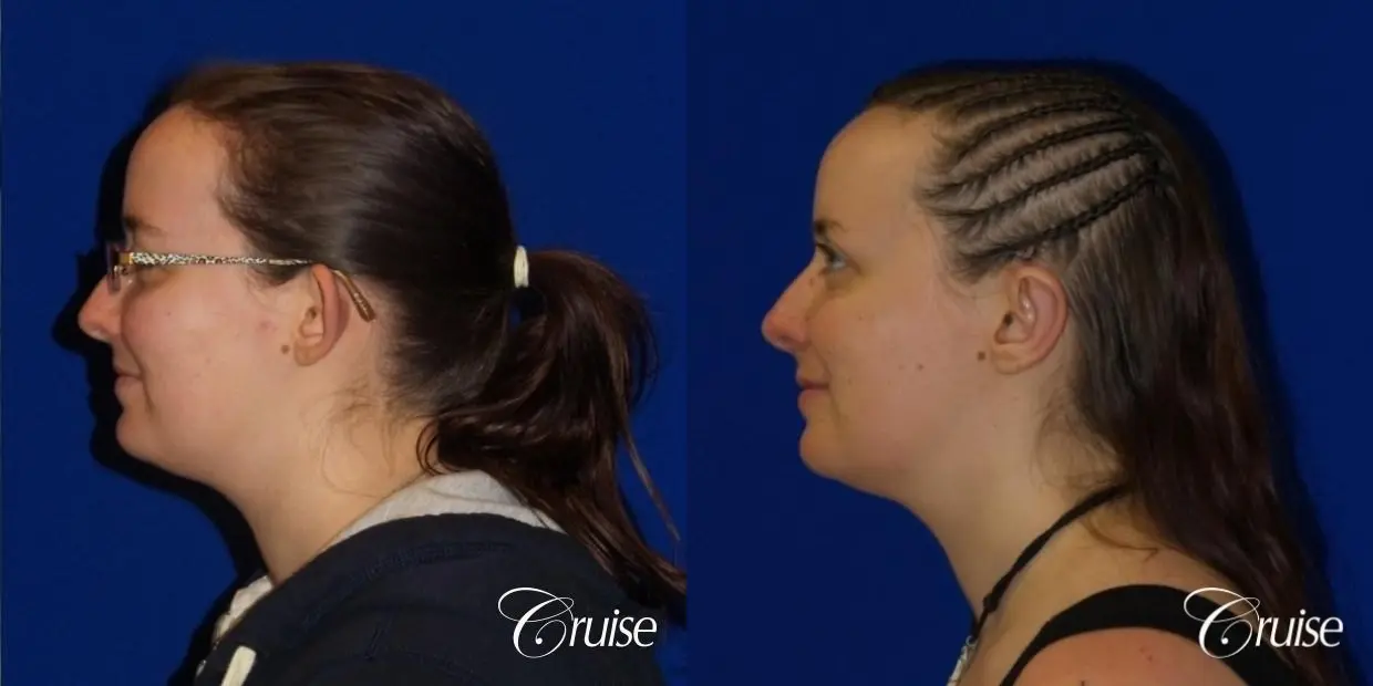 Otoplasty And Earlobe Repair: Patient 2 - Before and After 3