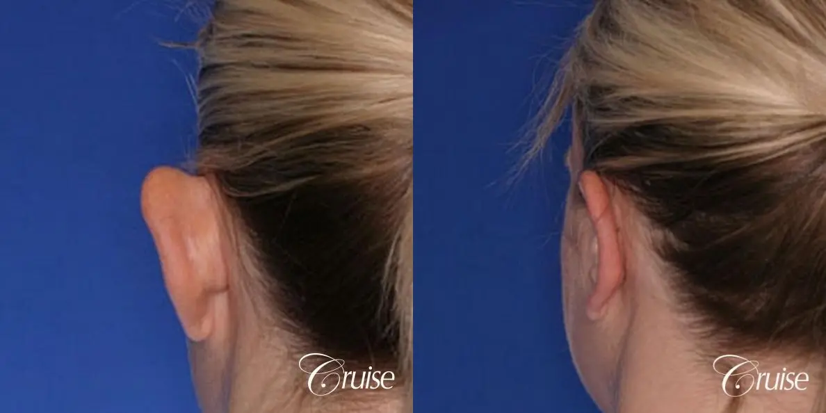 best otoplasty ear surgery by plastic surgeon in Newport Beach - Before and After 2