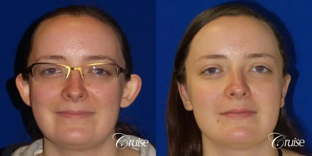 Otoplasty And Earlobe Repair: Patient 2 - Before and After  