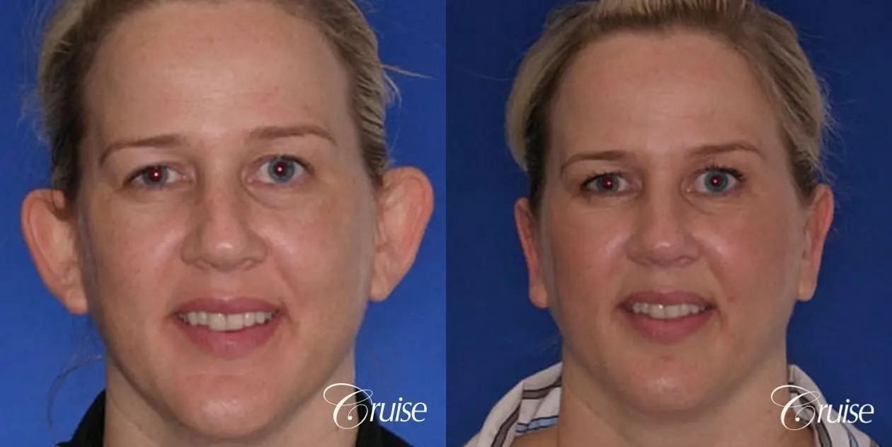 best otoplasty ear surgery by plastic surgeon in Newport Beach - Before and After 1