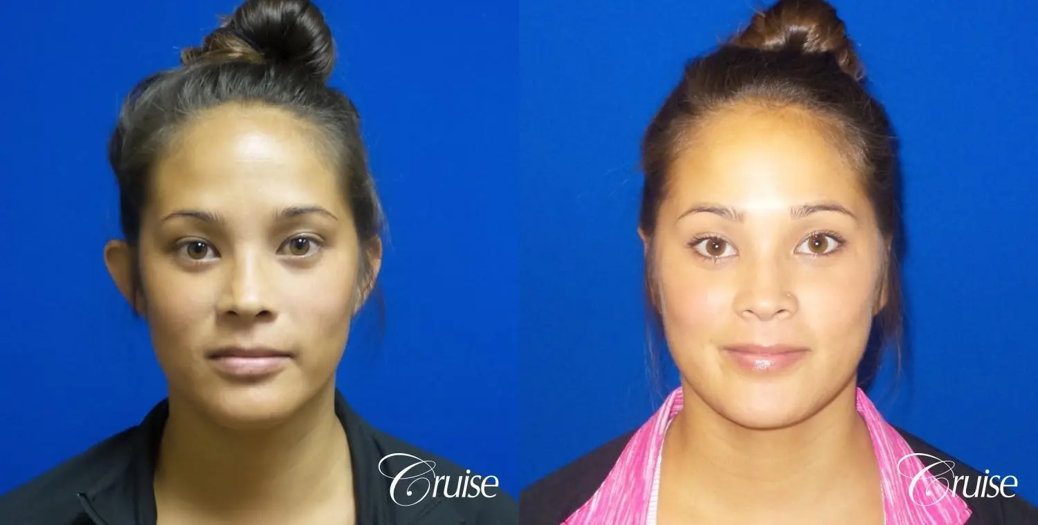 Otoplasty - Before and After 1