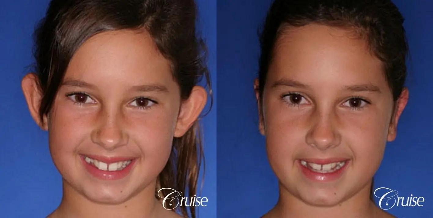 best otoplasty pictures on adolescent child teen - Before and After 1