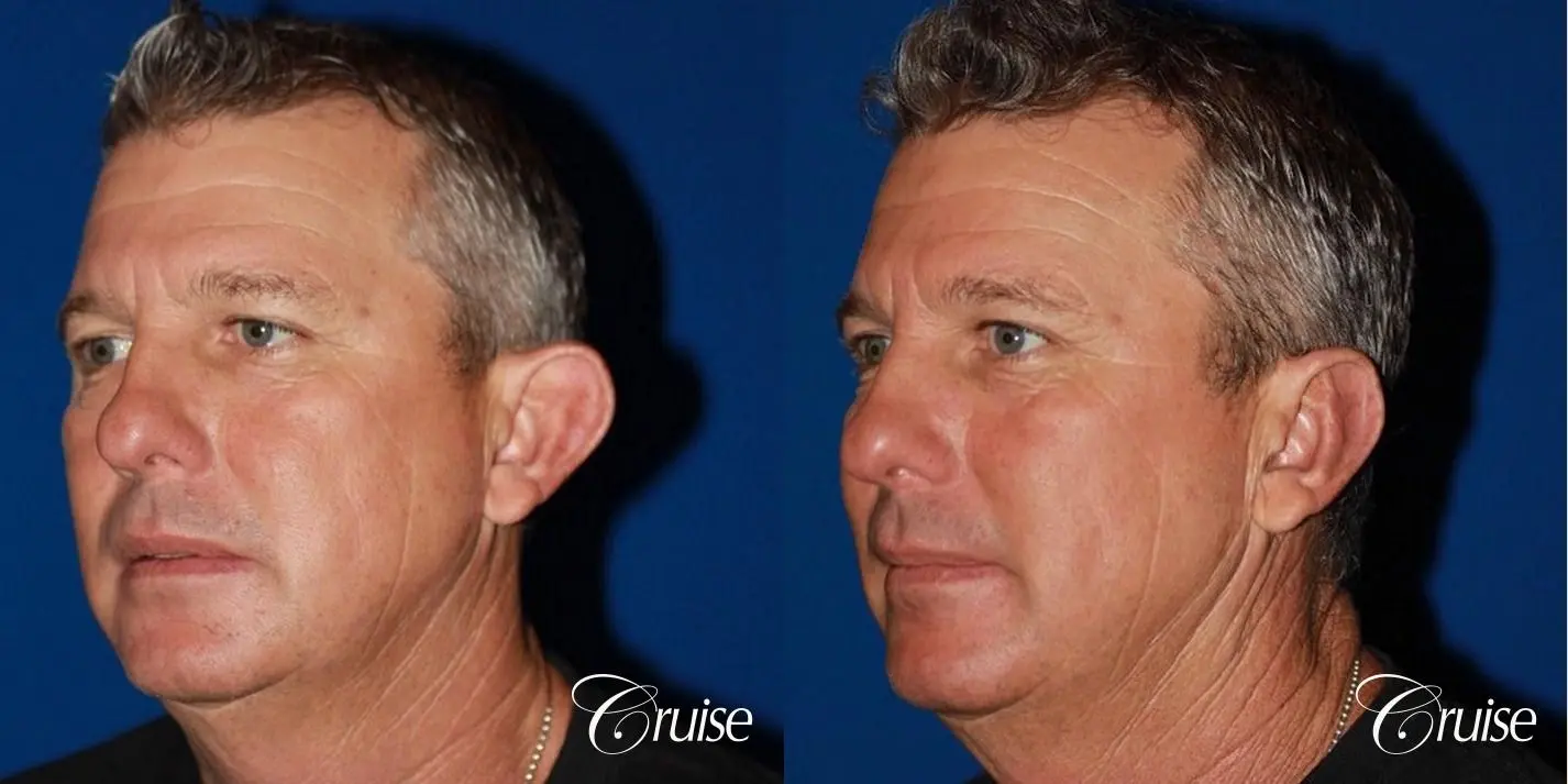 best pictures of otoplasty on male adult - Before and After 2