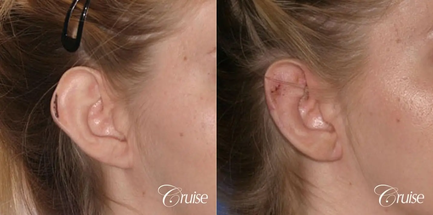 best otoplasty photos by top plastic surgeon - Before and After 2