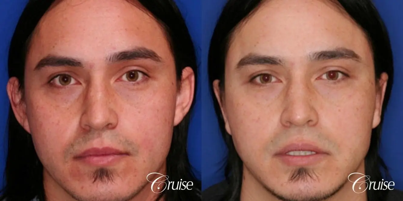 best male otoplasty orange county plastic surgeon - Before and After 1