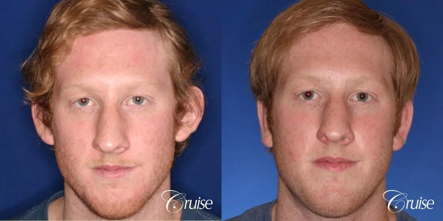 otoplasty before and after pictures newport beach - Before and After 1