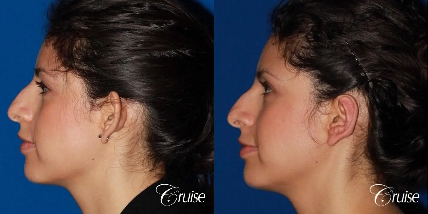 best otoplasty with natural appearance on female - Before and After 2