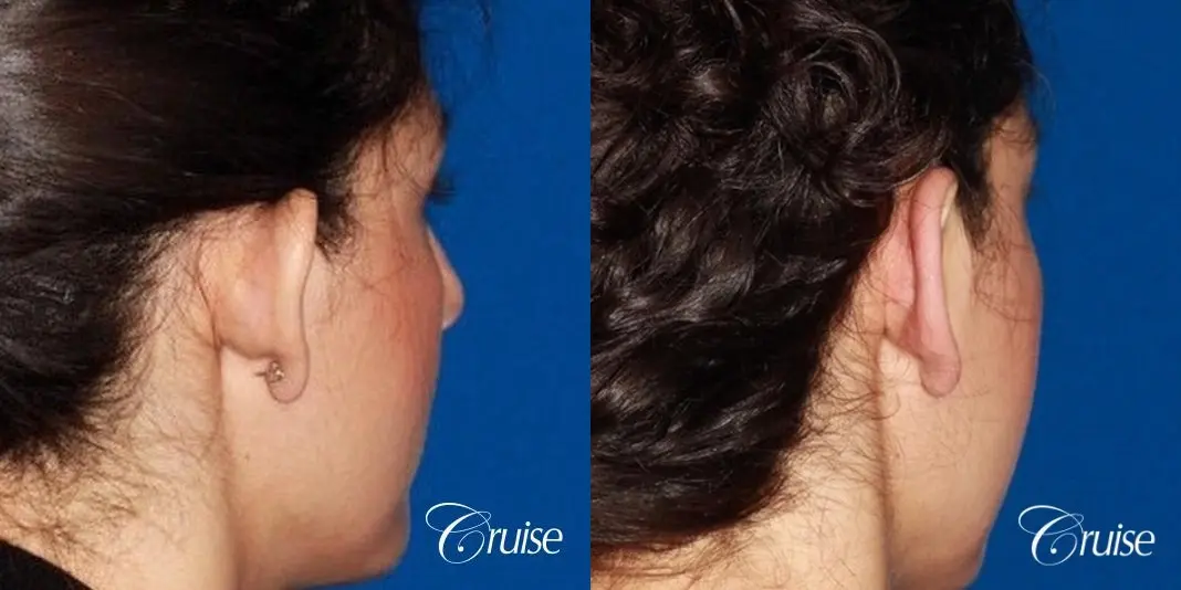 best otoplasty with natural appearance on female - Before and After 3