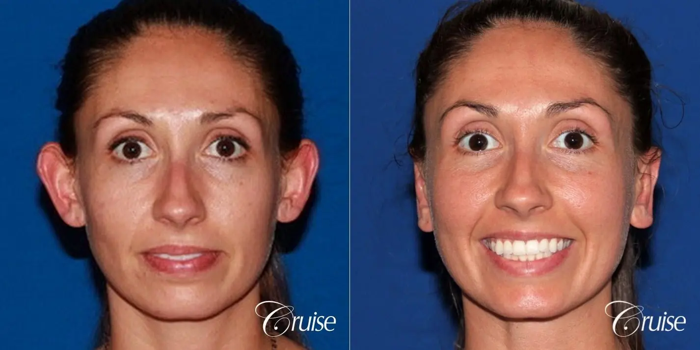 best adult otoplasty on women - Before and After 1