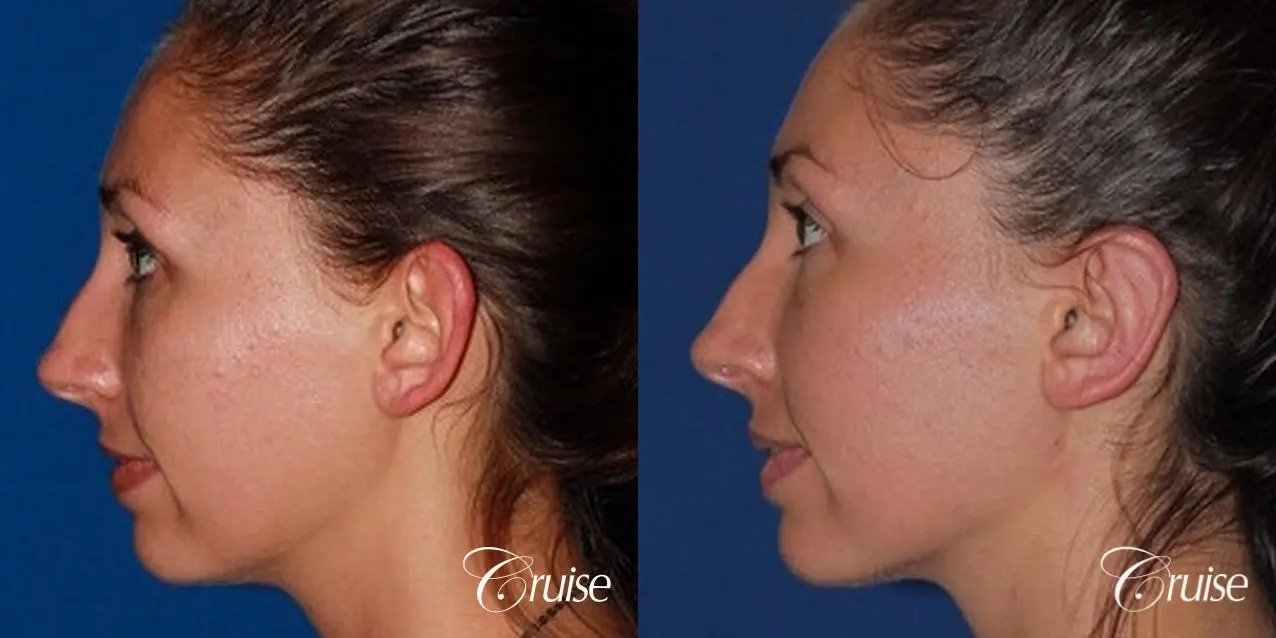 best adult otoplasty on women - Before and After 3