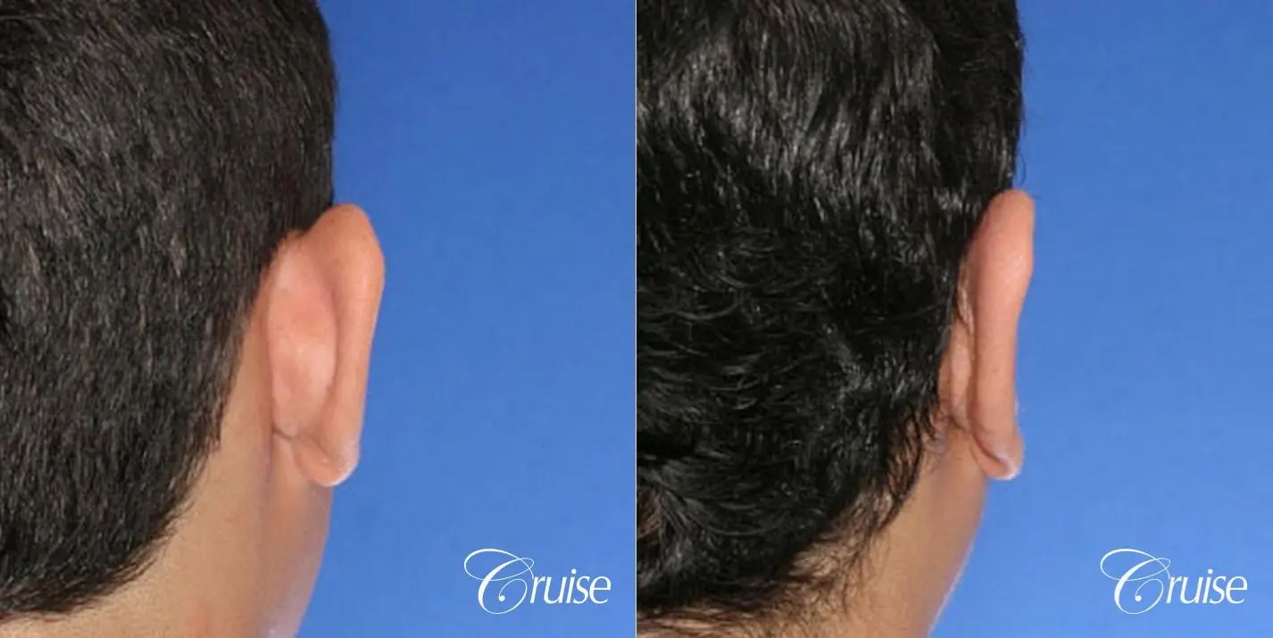 best otoplasty pictures on male teen in Newport Beach - Before and After 2