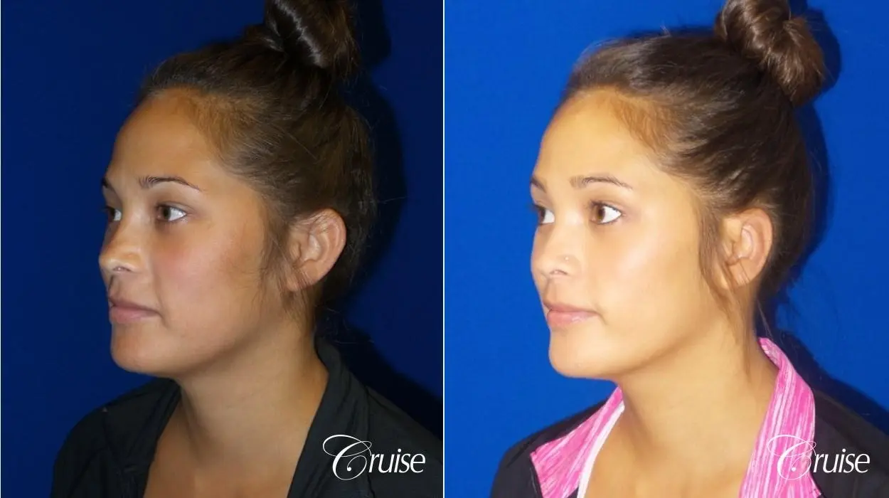 Otoplasty - Before and After 2