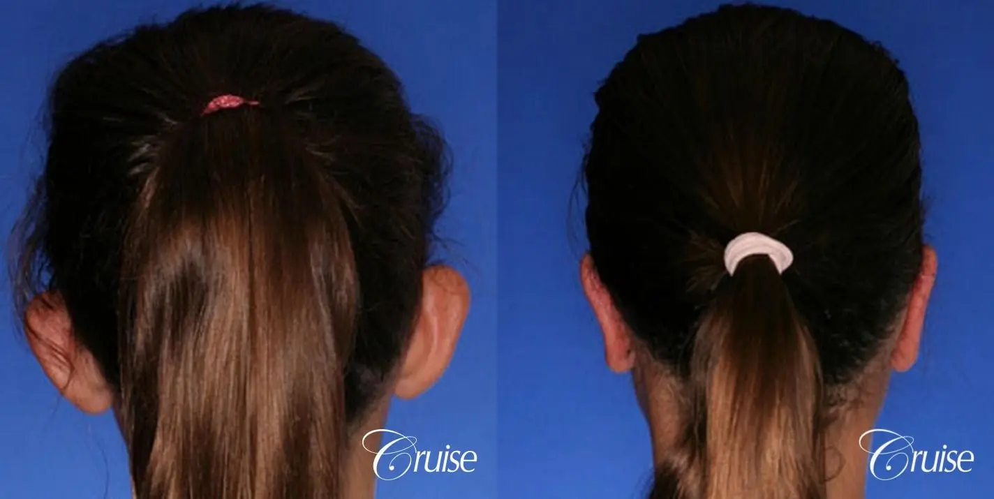 best otoplasty pictures on adolescent child teen - Before and After 3