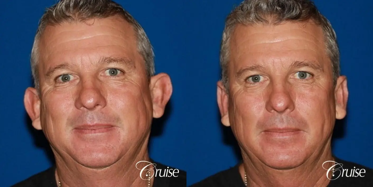 Facelift for Men Newport Beach & Orange County