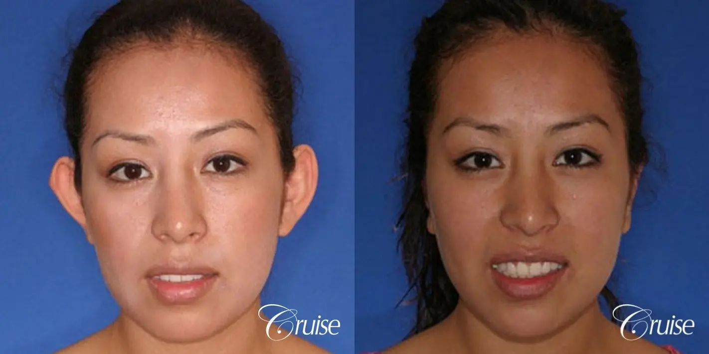 plastic surgeon does otoplasty in Newport beach - Before and After 1