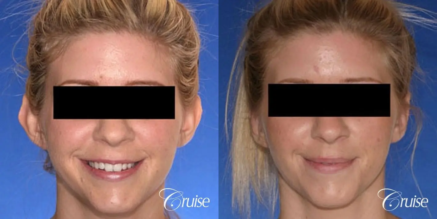 best otoplasty photos by top plastic surgeon - Before and After 1