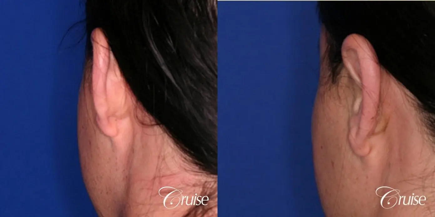 best male otoplasty orange county plastic surgeon - Before and After 2