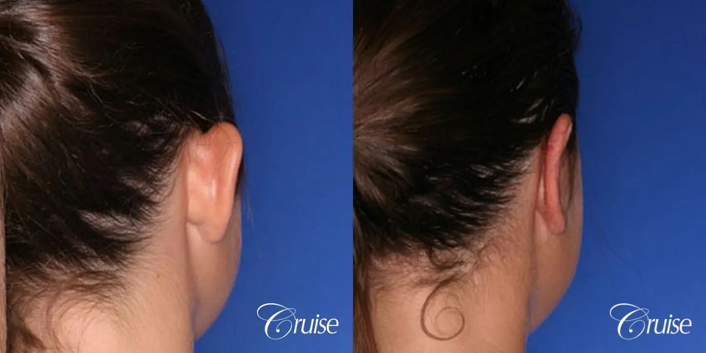 best otoplasty pictures on adolescent child teen - Before and After 2