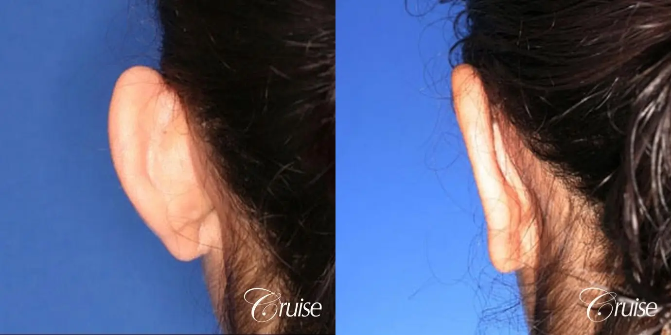 plastic surgeon does otoplasty in Newport beach - Before and After 3