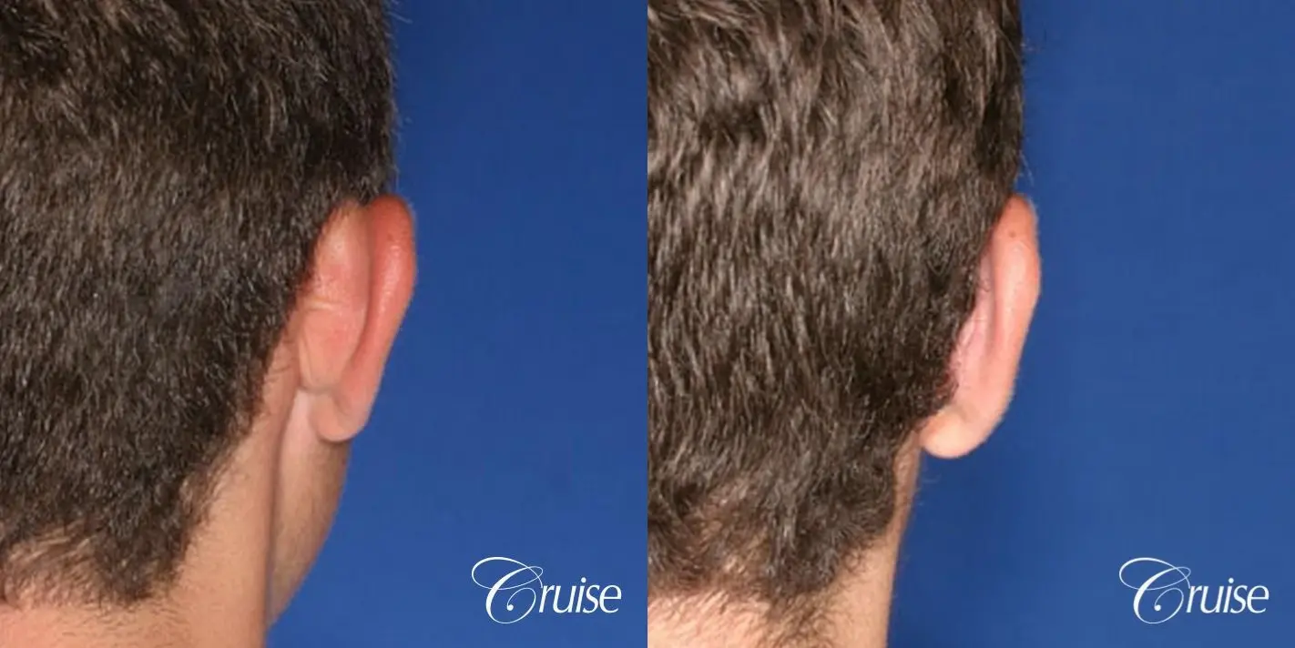 best plastic surgeon eye pinning male newport beach - Before and After 2