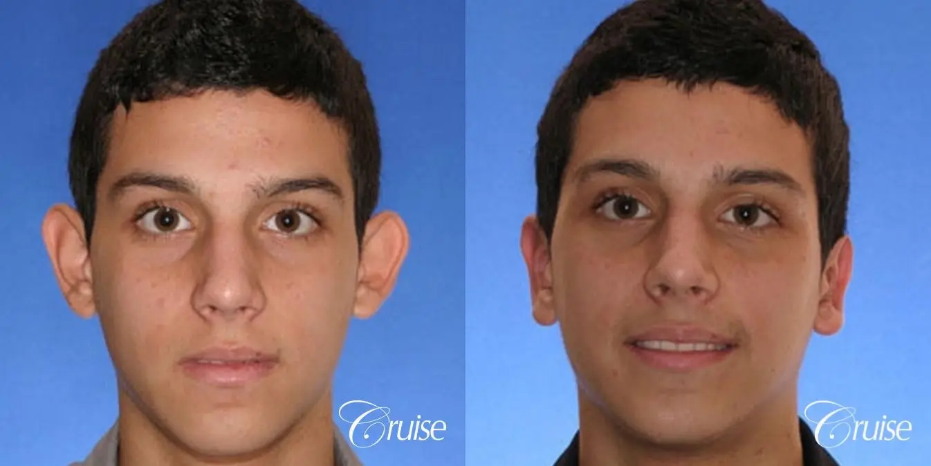 best otoplasty pictures on male teen in Newport Beach - Before and After